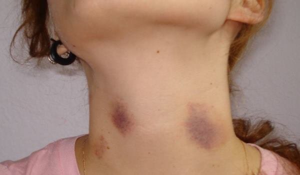 how to get rid of hickeys quick how to get rid of hickeys quick