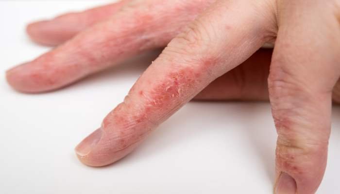 Best Natural Skin Oil For Eczema Best Natural Skin Oil For Eczema